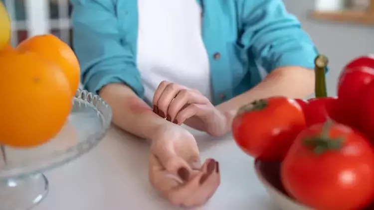 Alerjik Durumlar / Hastalıklar Nedir?