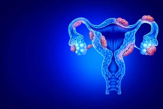 Endometriozis Nedir?